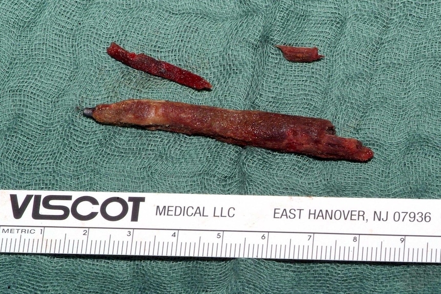 Pencil removed from head.