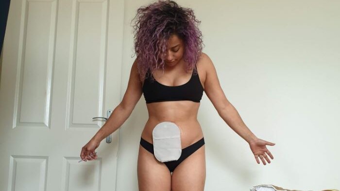Living with a stoma pouch: What a 39-year-old colorectal cancer survivor  and doctors want you to know - TODAY