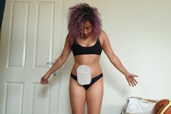 Dahlia Matkovic with her arms spread by her side, showing her ileostomy bag attached to her stomach