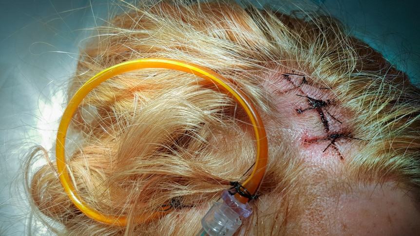 Top of a woman's head taken after brain surgery with a tube coming out of wound with stiches.