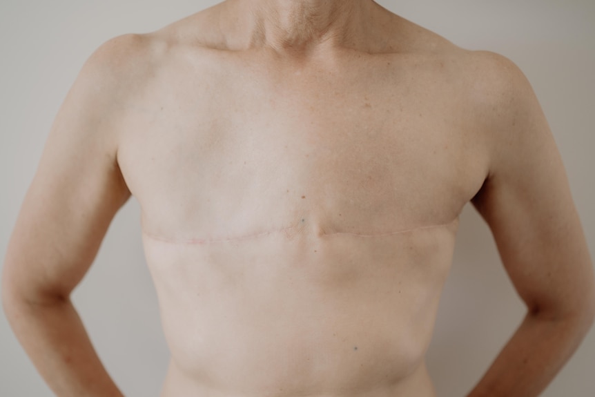 Scars from a mastectomy 