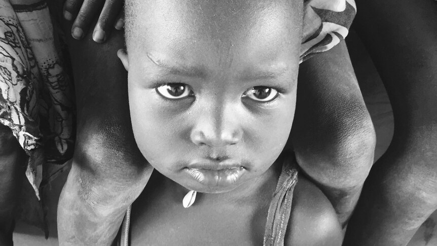 A child at a malnutrition assessment centre in Kapoeta, South Sudan.