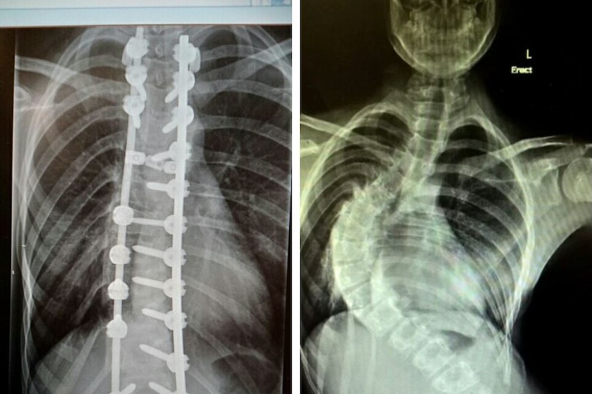 Opposing x-ray images of a spine before and after surgery to fix severe scoliosis.