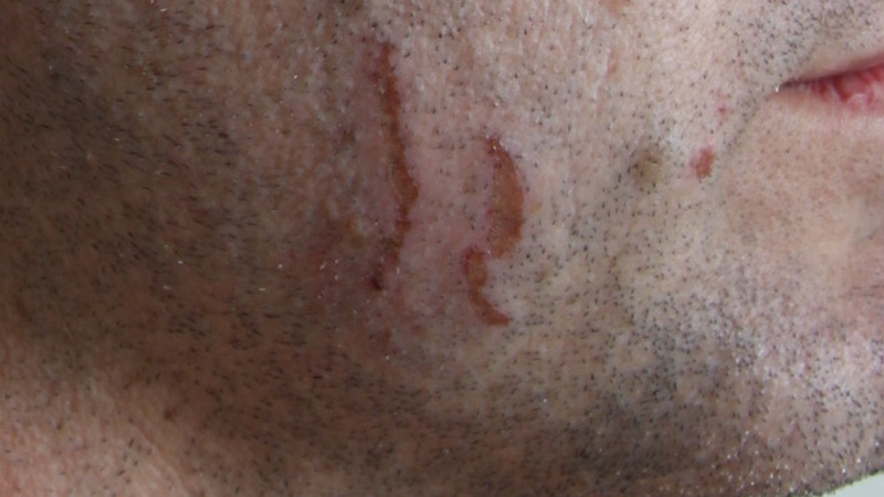 A court photo shows marks on the face and chest of accused murderer Gerard Baden-Clay.