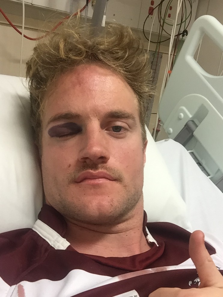 Lewis Freeth with a black eye from concussion