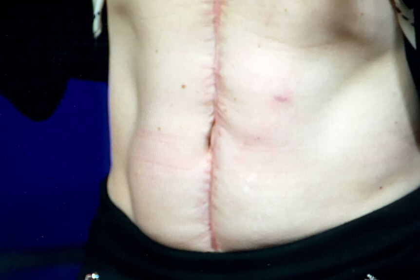 Leonie Stuart shows the scar running the length of her torso.