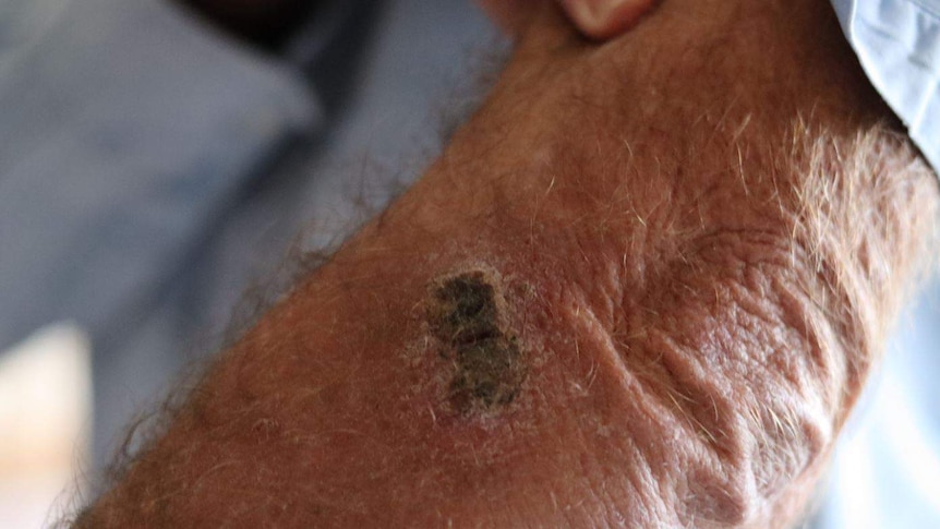 A scab on a man's arm