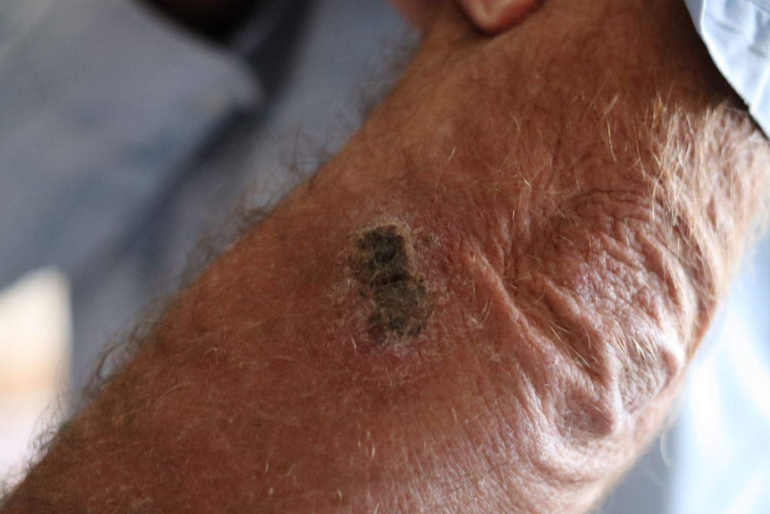 A scab on a man's arm