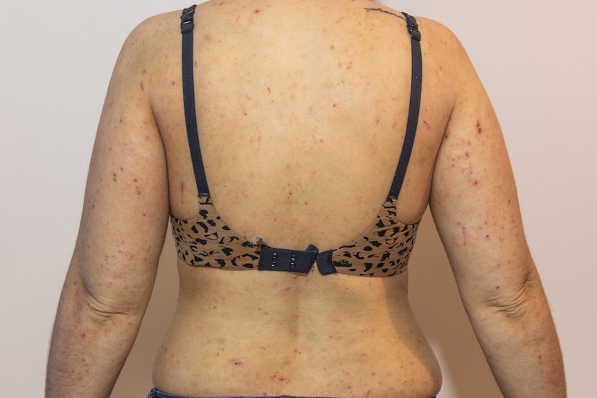 A woman's back and arms covered in eczema 