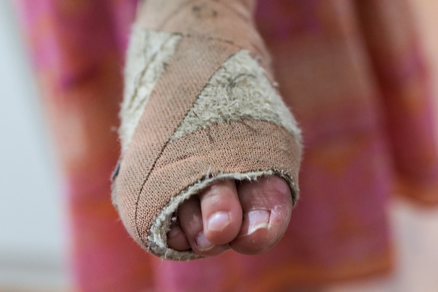 Close up of child's bandaged foot with four toes visible
