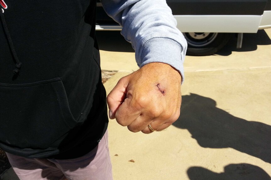 Surfer's hand after shark attack