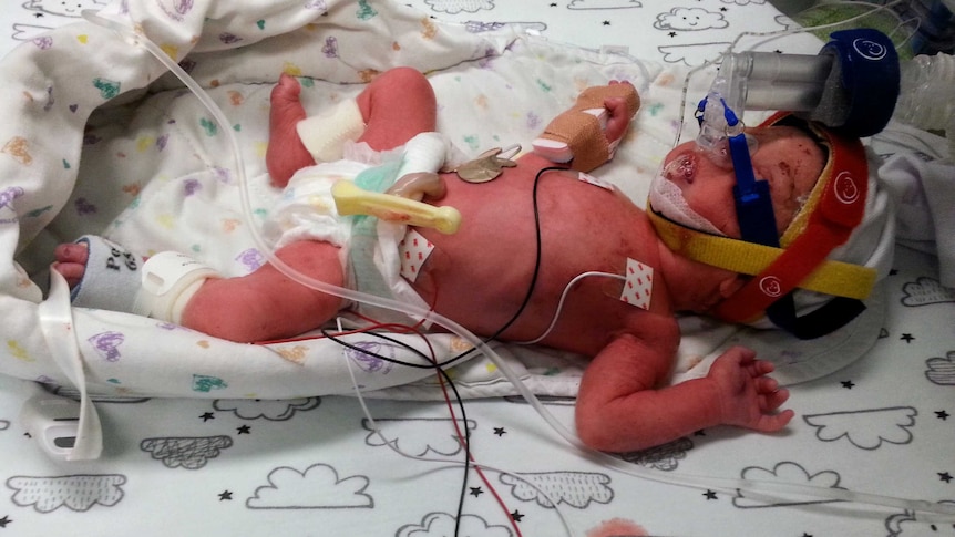 A prematurely born baby in a neonatal intensive care unit.