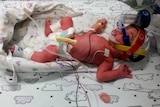 A prematurely born baby in a neonatal intensive care unit.