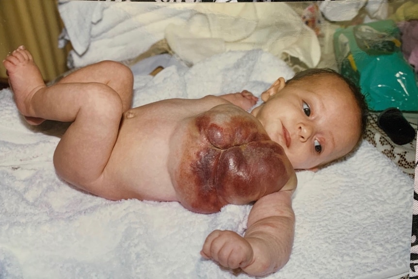 Caitlin Rutherford-Heard as a baby with a rare vascular malformation on her chest seen from the side.