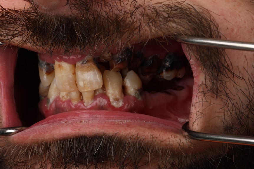 Close up of a man's damaged teeth with heavy plaque. 