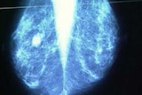 A new report reveals the number of women participating in breast screening continues to rise.