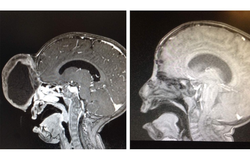Before and after magnetic resonance imaging (MRI) scans show the amazing transformation of Jhonny's face
