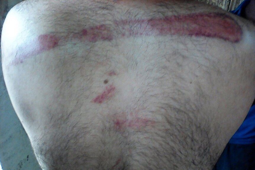 A red large welt on the back of a man.