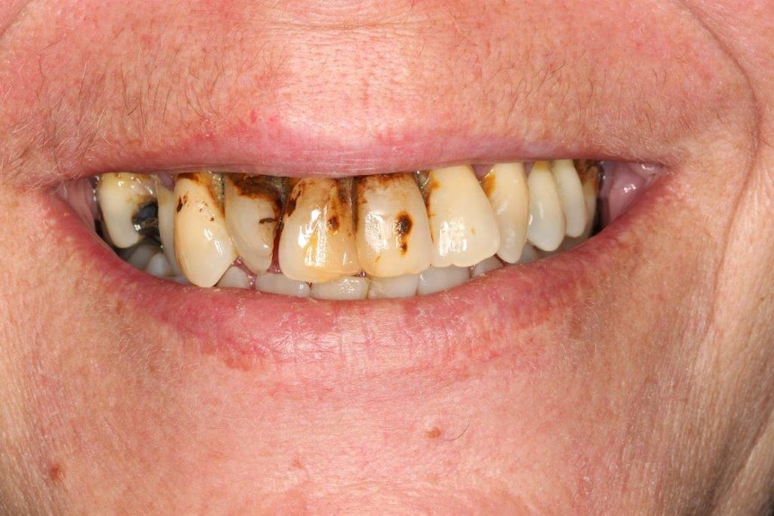 Person with gum disease and tooth decay
