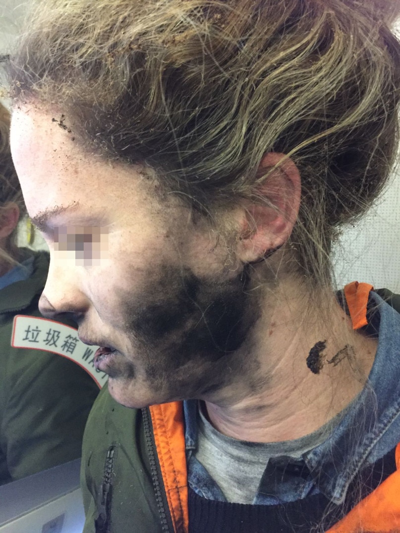 Burns caused to a woman's face after her headphones exploded on a flight.