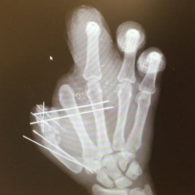 X-ray of Jason Pierre-Paul's mangled hand
