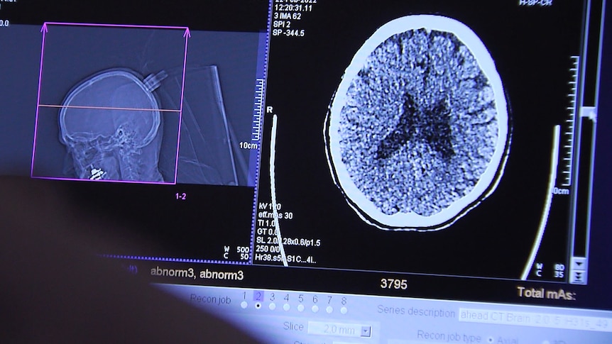 Why the world’s still waiting for a dementia cure, and what we can do in the meantime