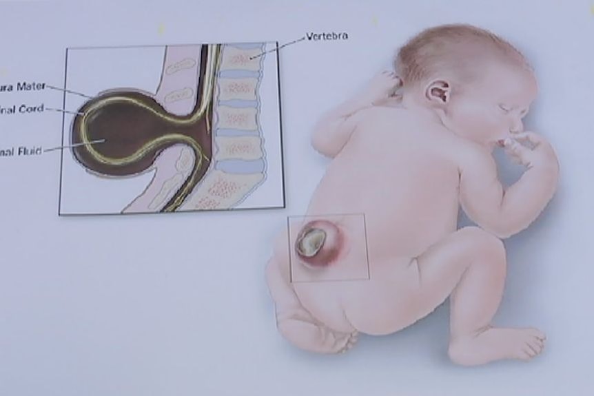 Diagram of in-utero spina bifida surgery