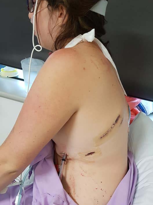 Amanda McDonald being treated in a hospital showing the scar on her side.