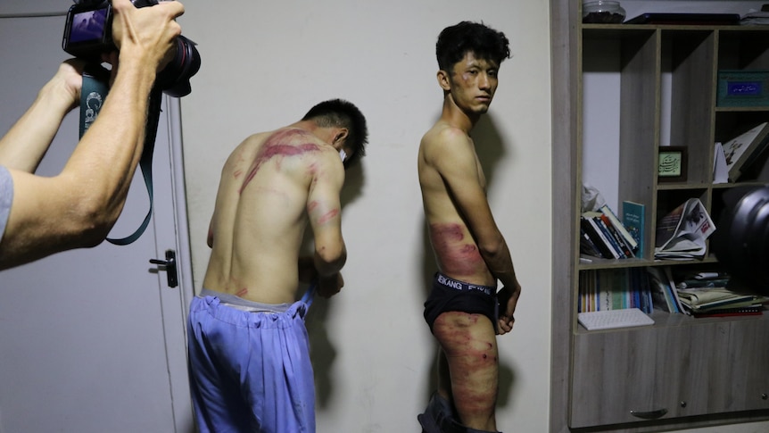 Journalists show their injuries after being beaten by the Taliban.