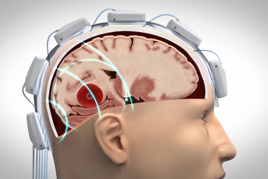 An animation showing sensors placed on a patient's head