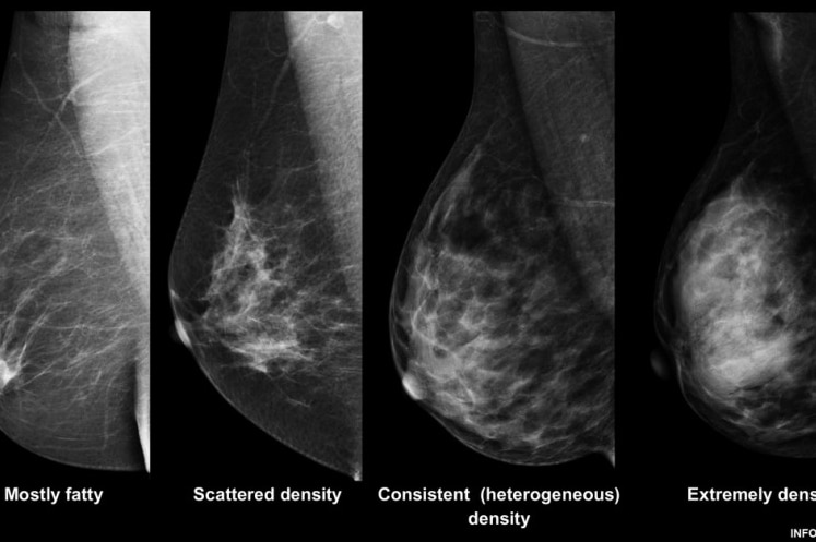 Breast density chart