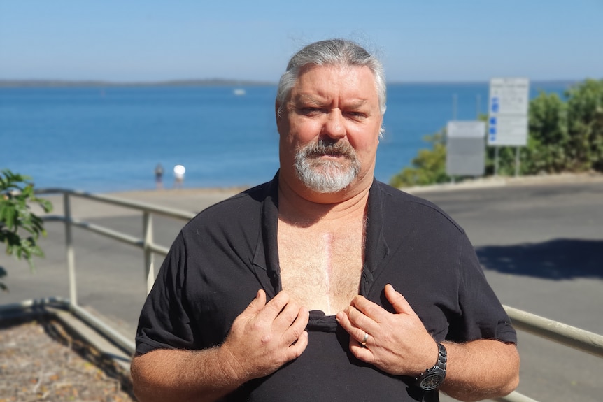 A man opens his shirt to show scar on his chest