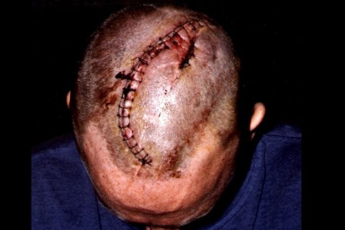 A large scar across Pritchard's head, after the Totem Pole accident.