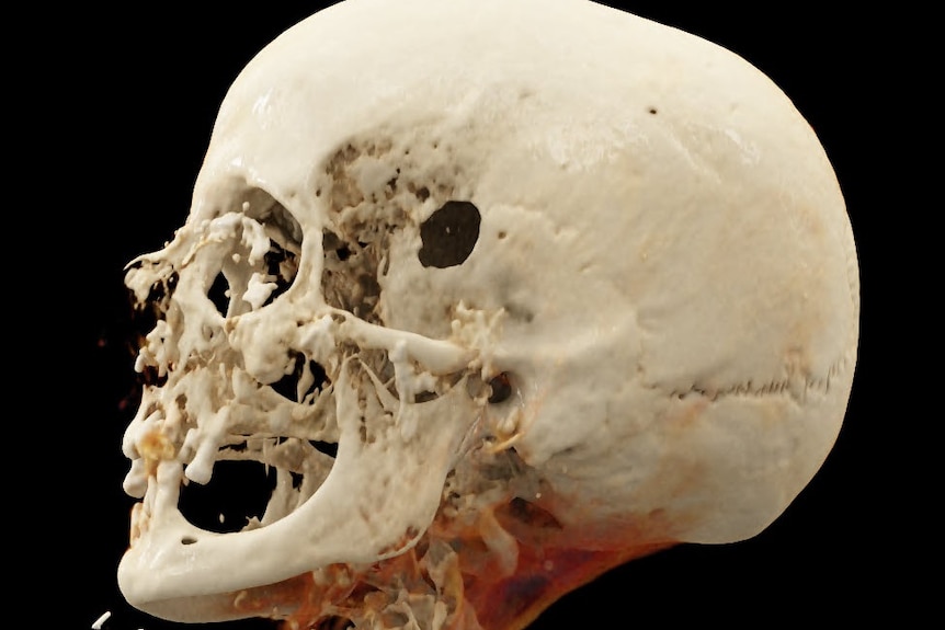 An image of a human skull with a small hole in it