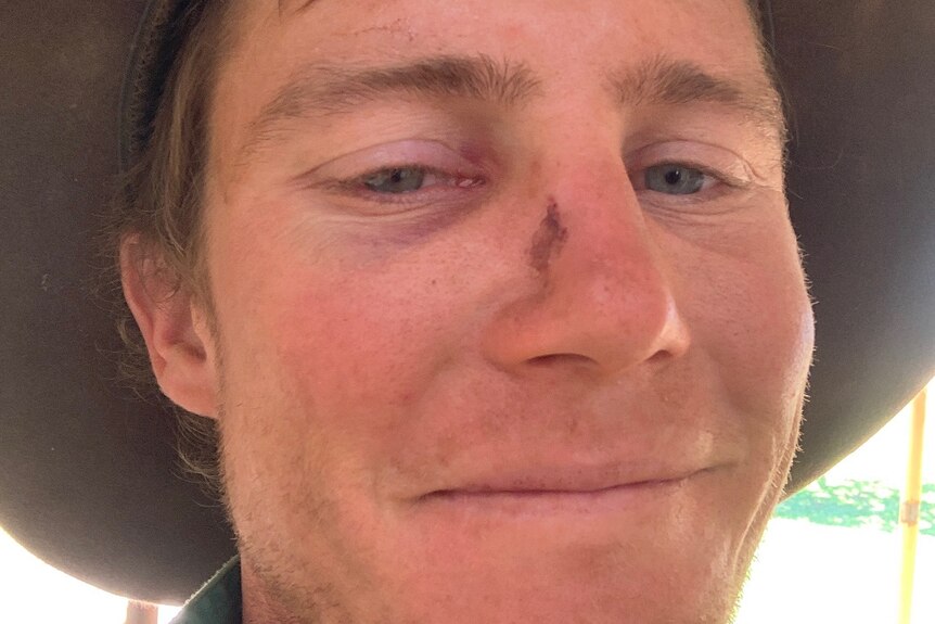 Cain Burns escaped being trampled by a bull with bruises and a scratch.