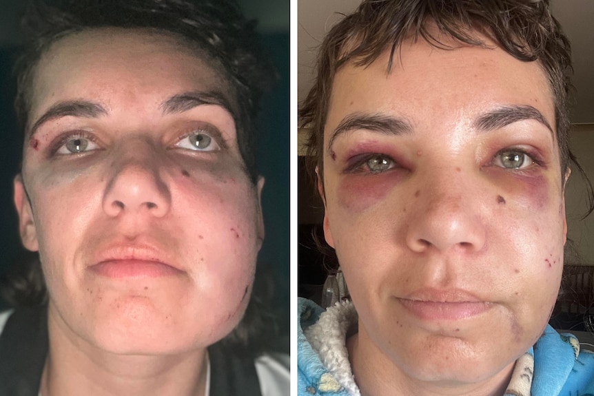 Three separate images detailing the injuries a woman suffered in a assault, showing black eyes and swelling.  
