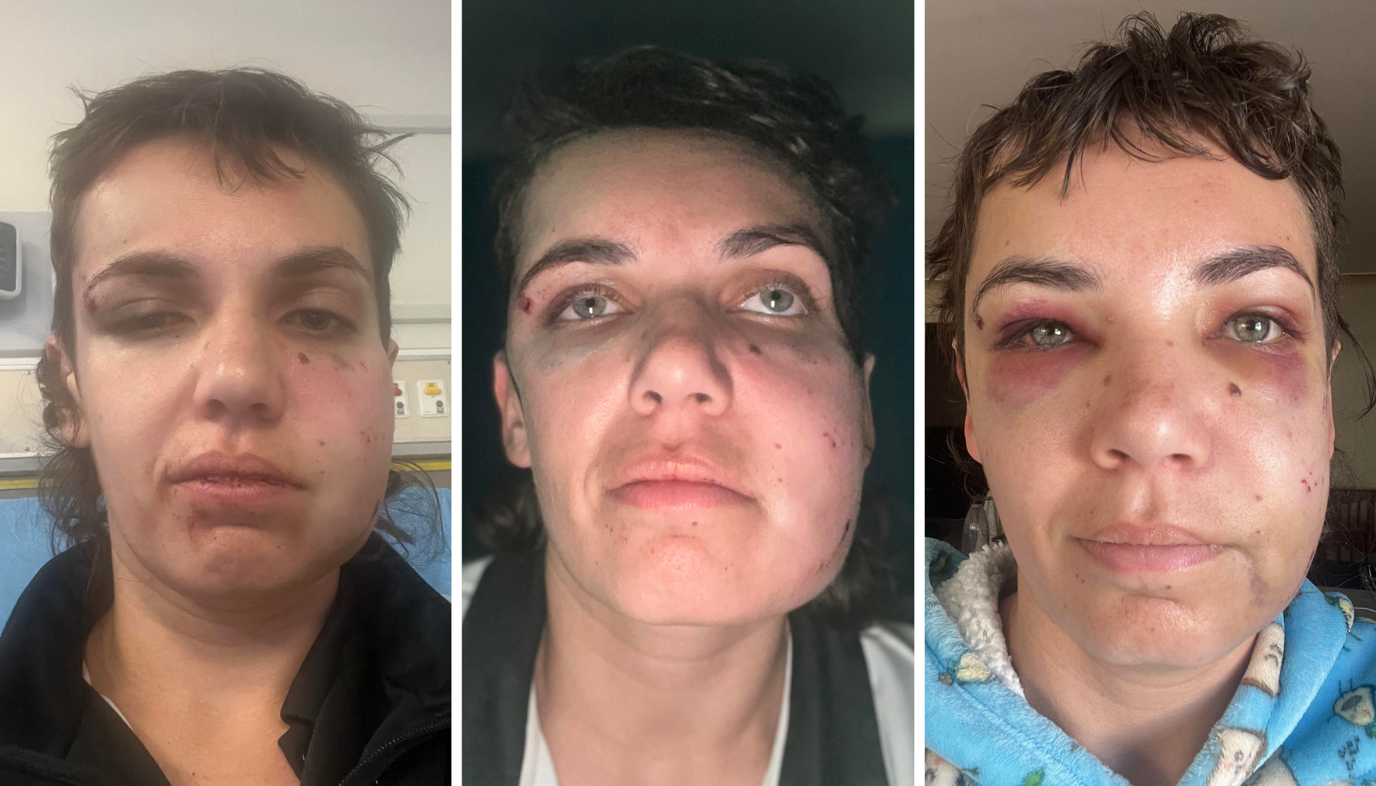 Three separate images detailing the injuries a woman suffered in a assault, showing black eyes and swelling.  