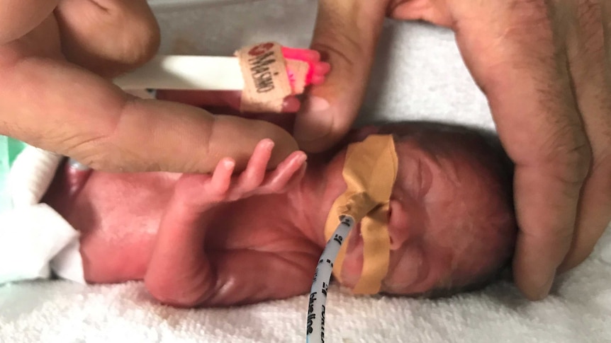 A small baby with a feeding tube in is compared to the size of a man's finger.