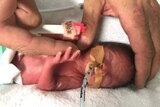 A small baby with a feeding tube in is compared to the size of a man's finger.