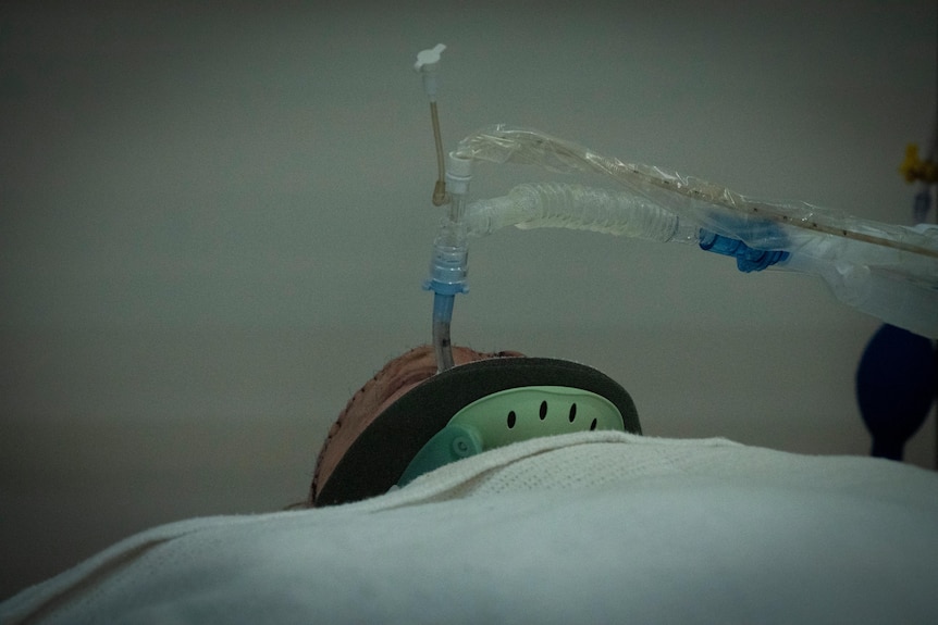A man lies in a hospital bed with a tube protruding from his mouth.