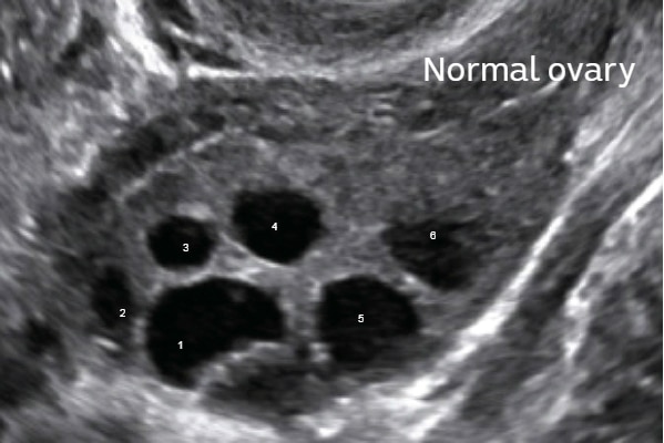 It is usual for women to develop about five larger follicles which mature during each menstrual cycle, as seen on this ultrasound of a normal ovary.