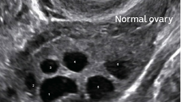 A dominant follicle is present on this ultrasound of healthy ovaries.