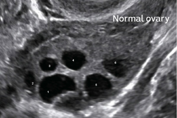 A dominant follicle is present on this ultrasound of healthy ovaries.