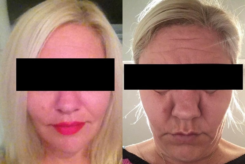 70-year-old Perth woman hits back at Botox claims