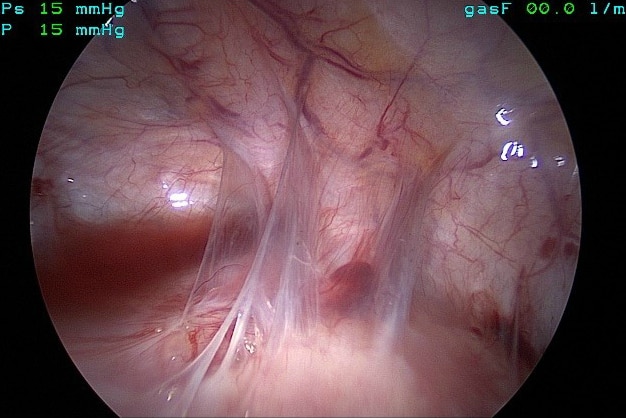 Endometriosis in Jessica Panetta.