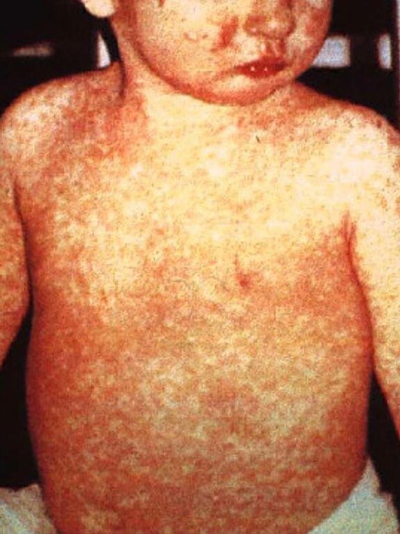 A child with day four measles rash.