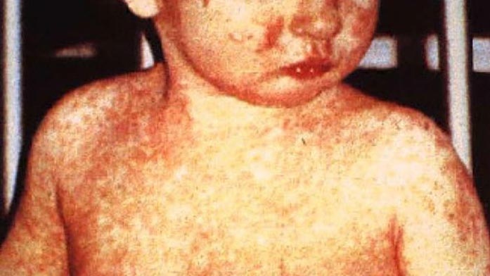 A child with day four measles rash.