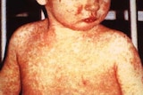 A child with day four measles rash.
