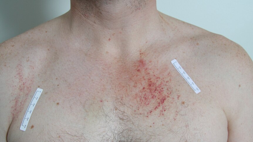 A photo released on March 20, 2013 shows marks on the torso of accused murderer Gerard Baden-Clay.