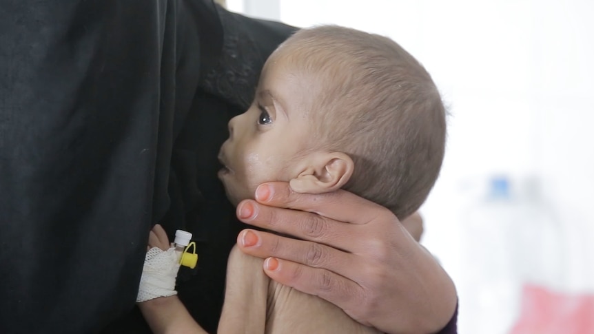 Baby in a feeding clinic in Yemen